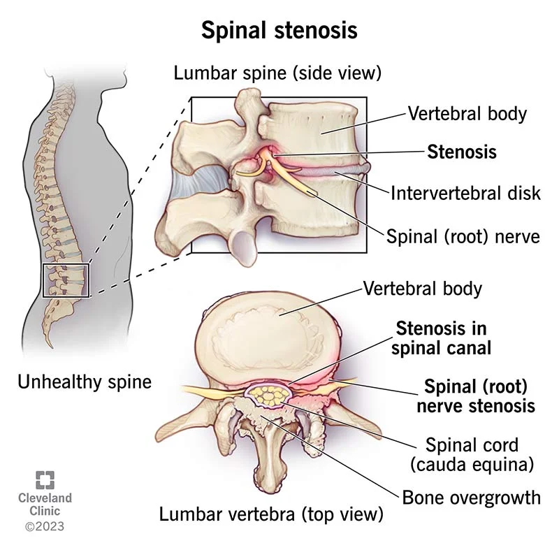 spinal stenosis treatment in chennai