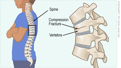vertebral compression fractures treatment in chennai