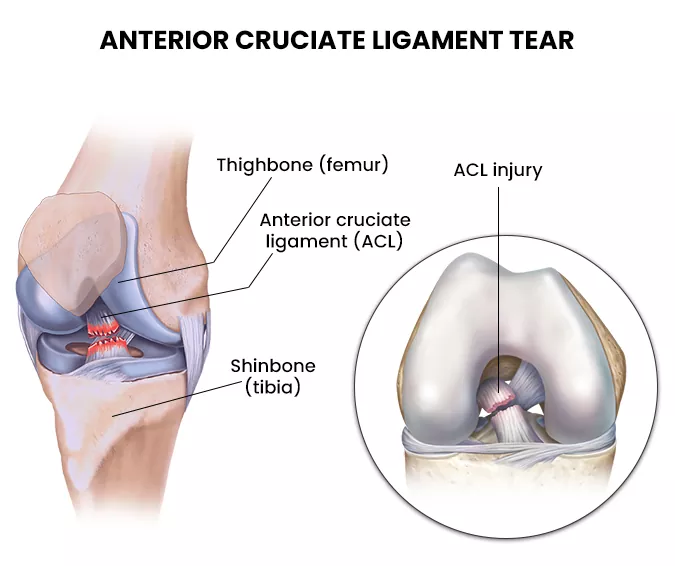 ACL Reconstruction Treatment in chennai