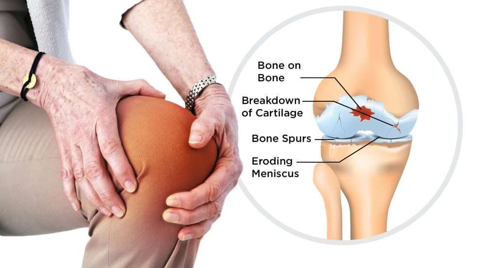 osteoarthritis treatment in chennai