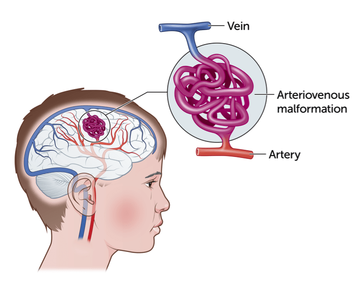Arteriovenous Malformations Treatment in Chennai