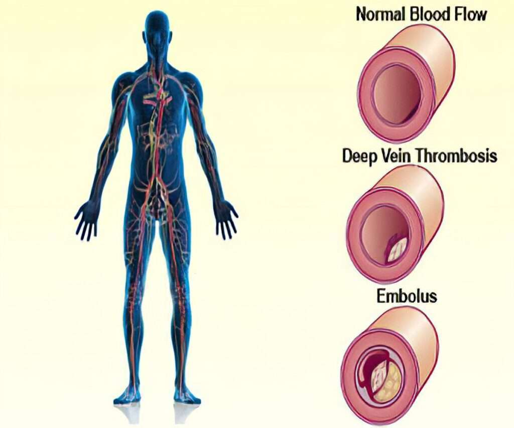 Deep Vein Thrombosis treatment in coimbatore