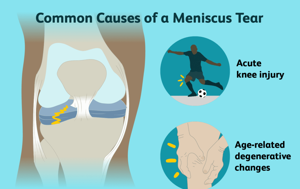 Meniscus Repair treatment in chennai