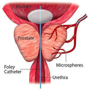 Prostate Artery Embolization treatment in chennai