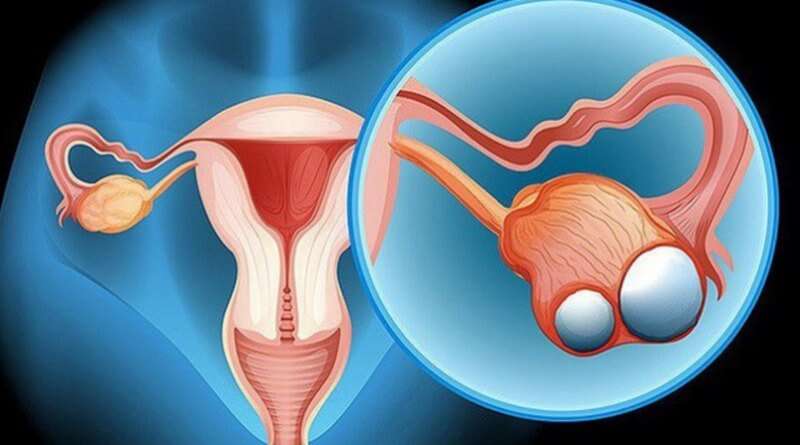I-fern Products. 001 - What is Ovarian Cyst? An ovarian cyst is a  fluid-filled sac within the ovary. Often they cause no symptoms.  Occasionally they may produce bloating, lower abdominal pain, or